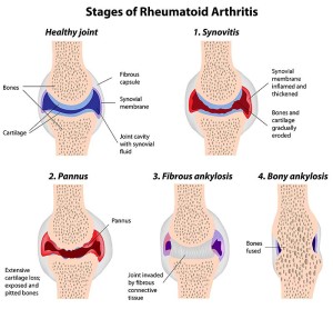 stages of rheumatoid arthritis